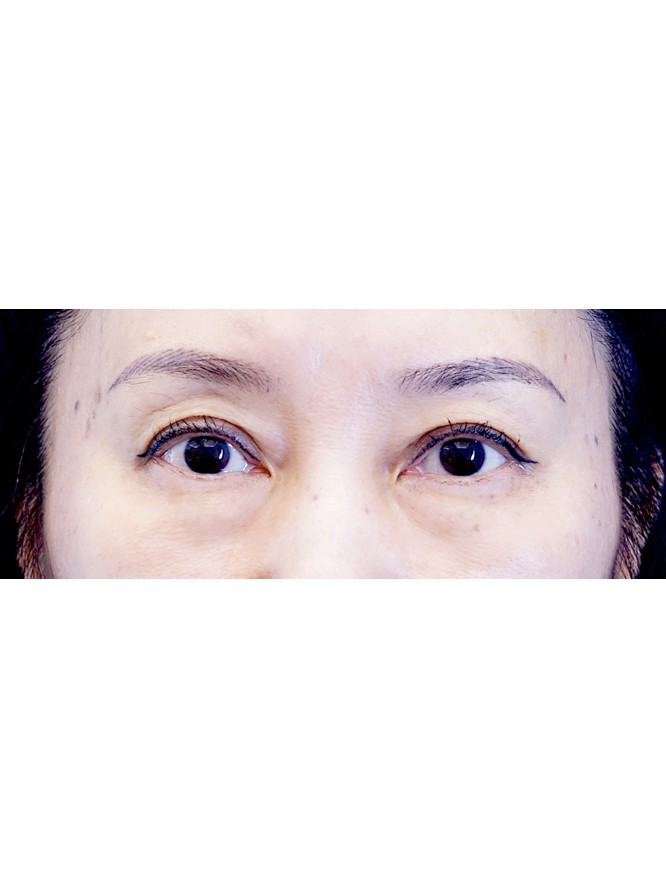 Lower Blepharoplasty with Fat Repositioning