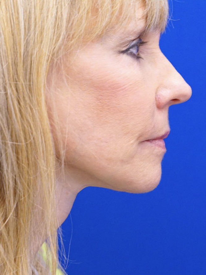 Neck Rejuvenation