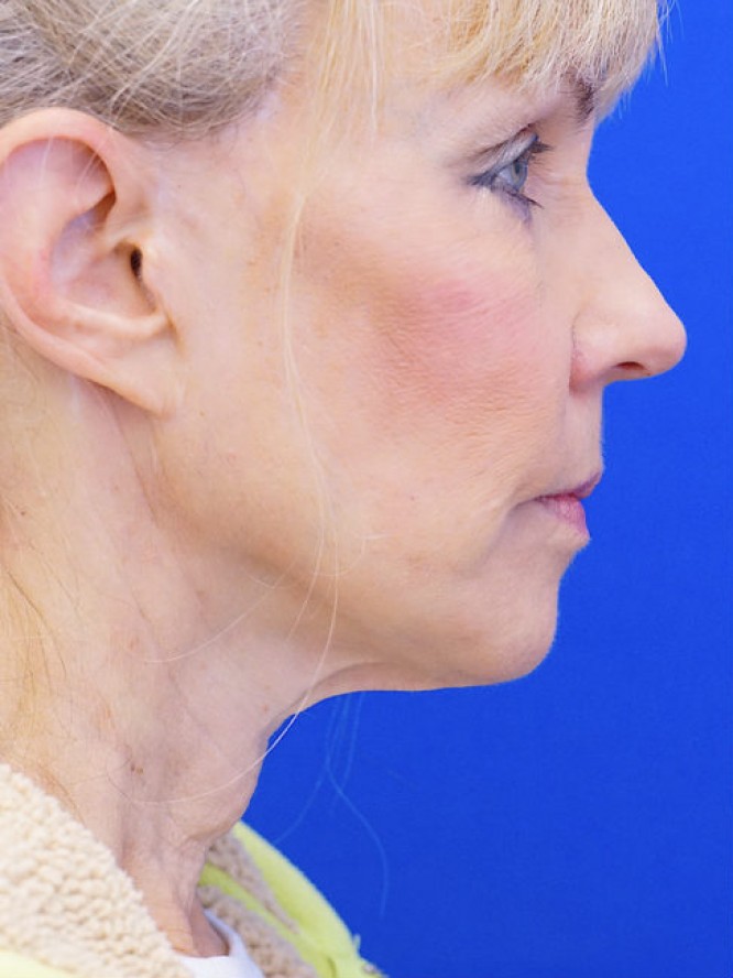 Neck Rejuvenation