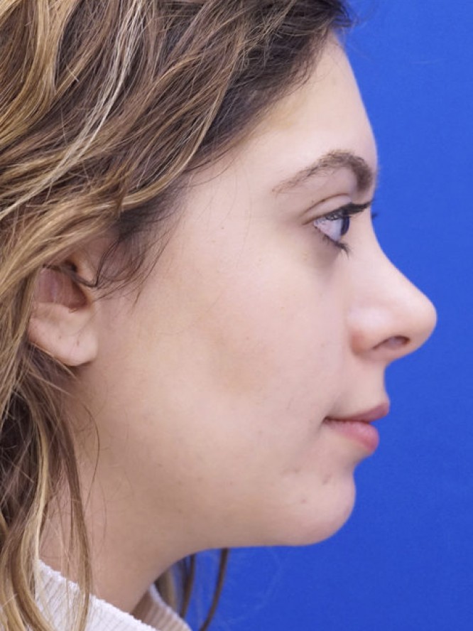 Hump Reduction and Chin Projection