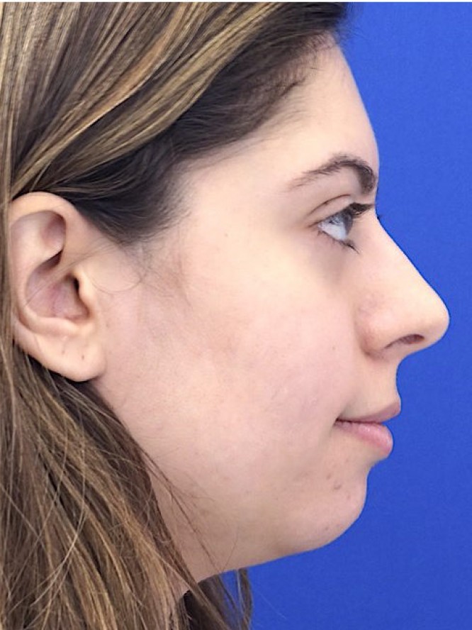 Hump Reduction and Chin Projection