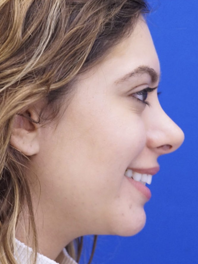 Hump Reduction and Chin Projection