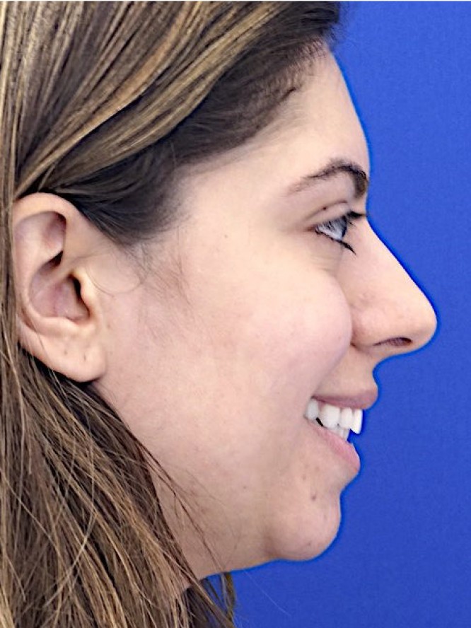 Hump Reduction and Chin Projection
