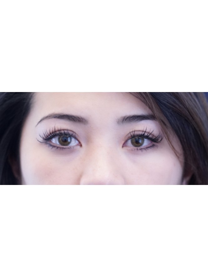 Asian Eyelid Definition