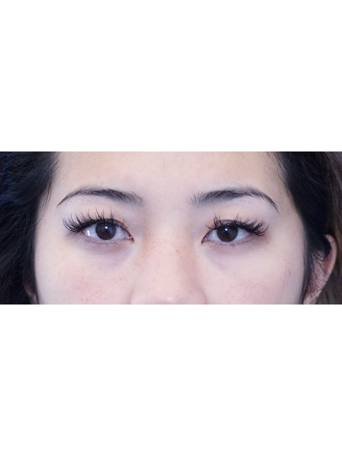 Asian Eyelid Definition