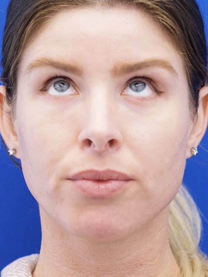 Lower Eyelid Skin Laxity