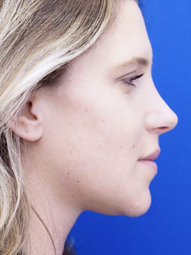 Aesthetic Nasal Profile 3091