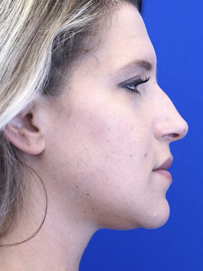 Aesthetic Nasal Profile 3091