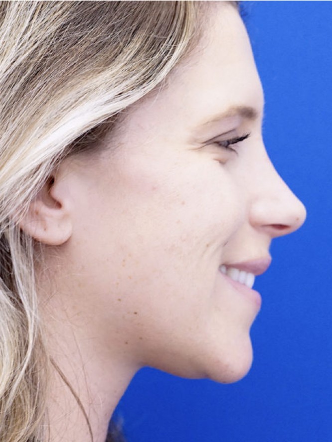 Aesthetic Nasal Profile