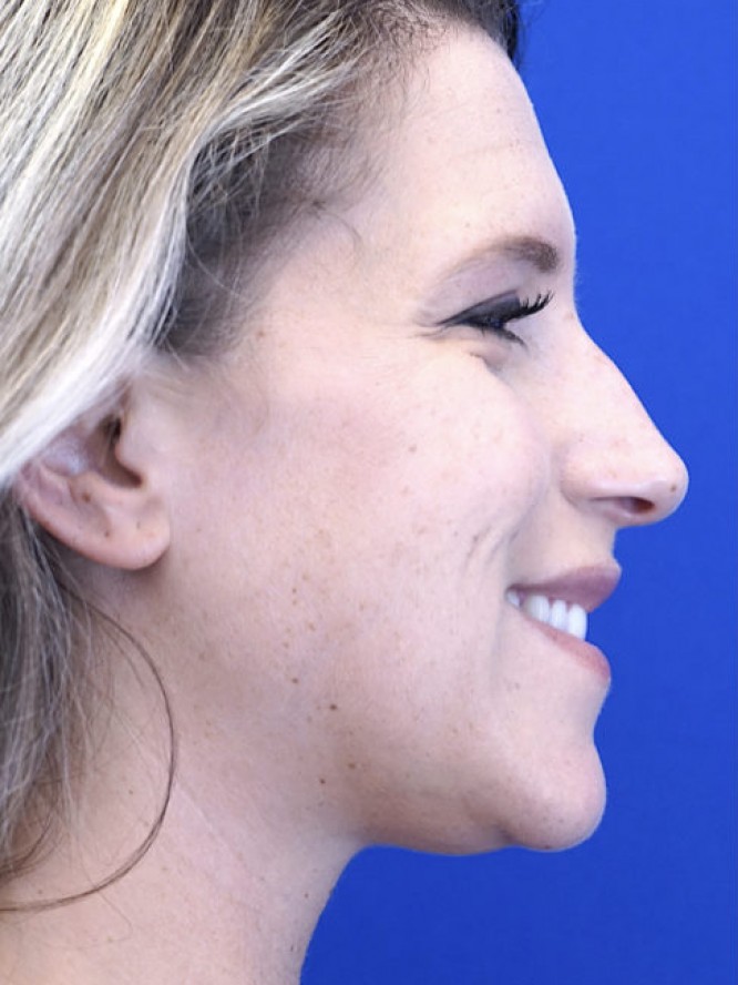 Aesthetic Nasal Profile