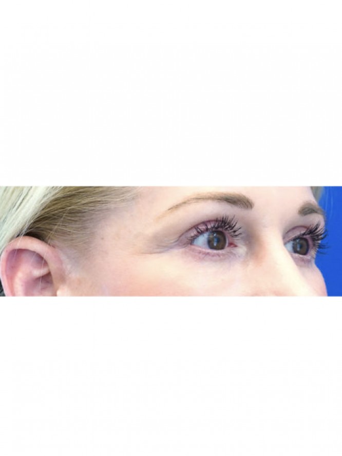 Lower Blepharoplasty and Fat Grafting