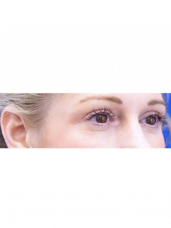 Lower Blepharoplasty and Fat Grafting