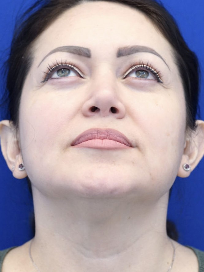 Nasal Tip Asymmetry