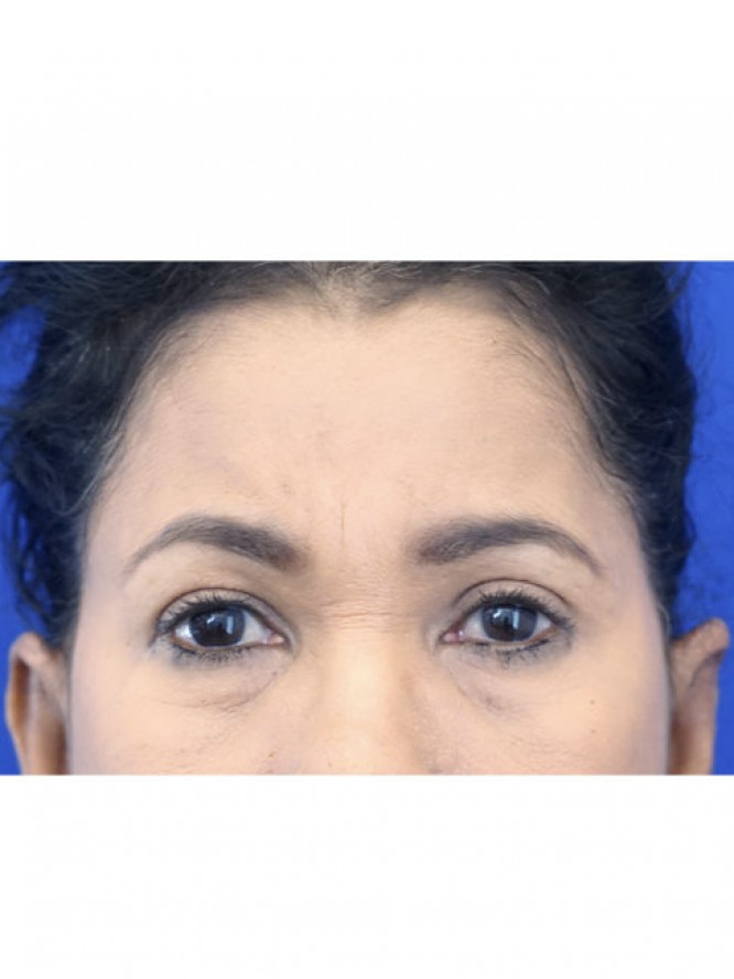 Endoscopic Forehead Lift