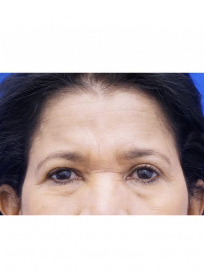 Endoscopic Forehead Lift