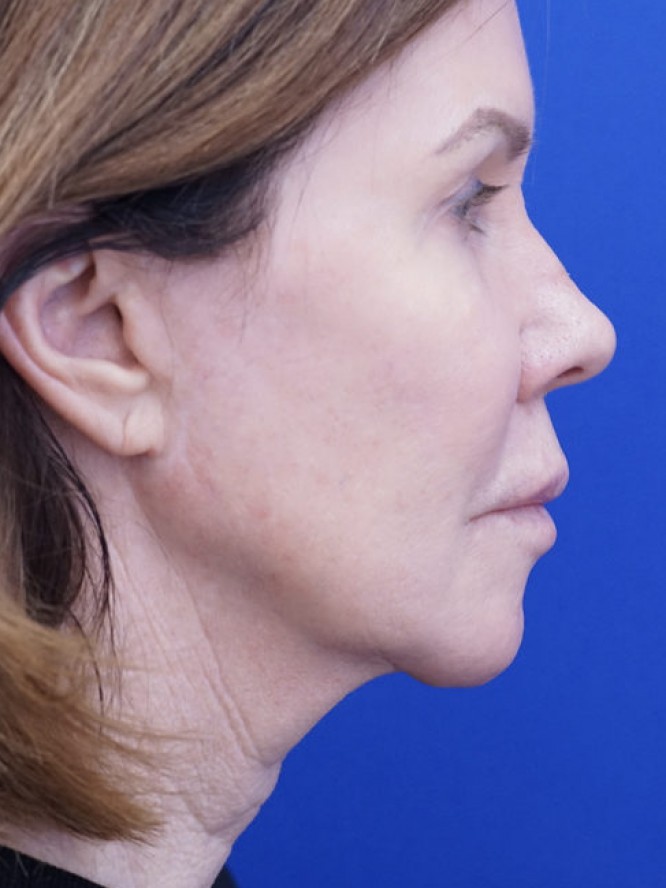 Secondary Lift and Facial Fat Grafting