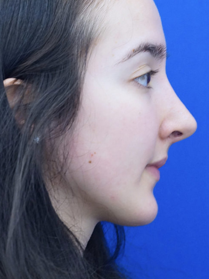 Endonasal Finesse Rhinoplasty