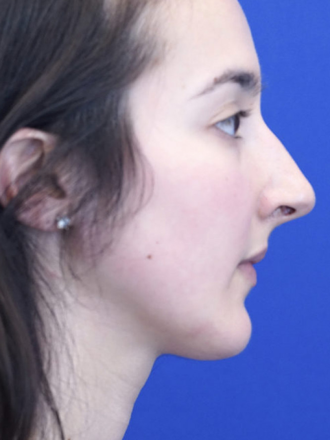 Endonasal Finesse Rhinoplasty