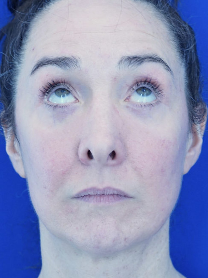 Quad Eyelid Blepharoplasty with Fat Reposition