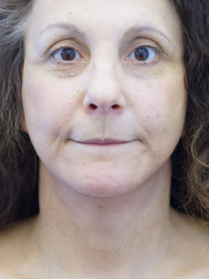 Deep Plane Facelift and Platysmaplasty