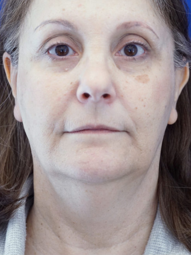 Deep Plane Facelift and Platysmaplasty