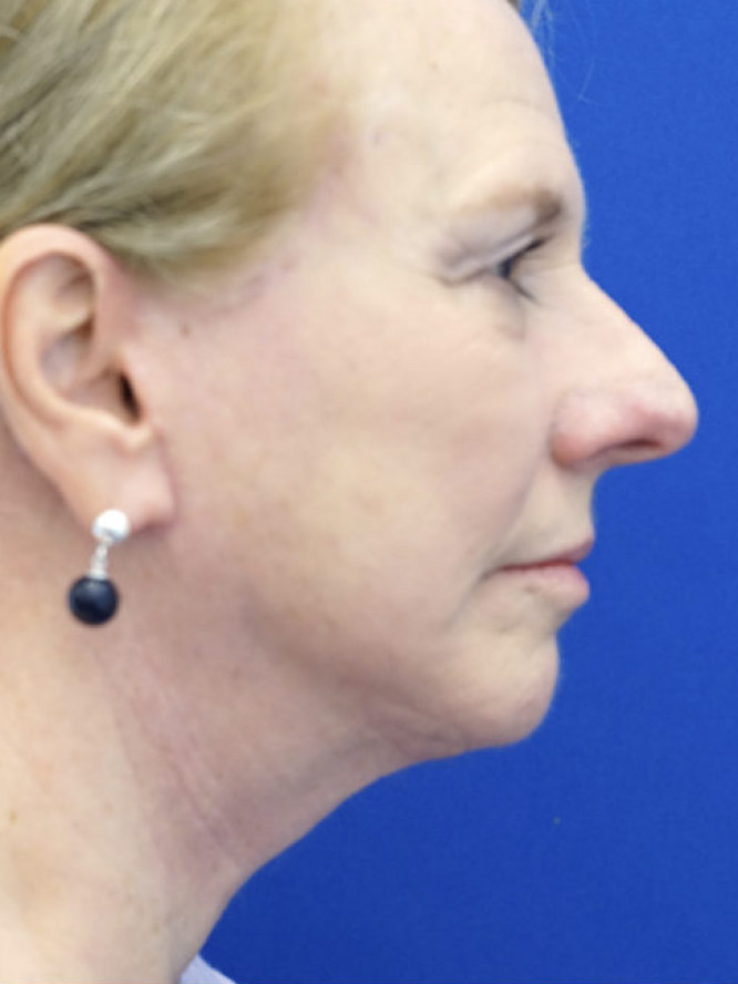 Lower Facial Aging and Fullness
