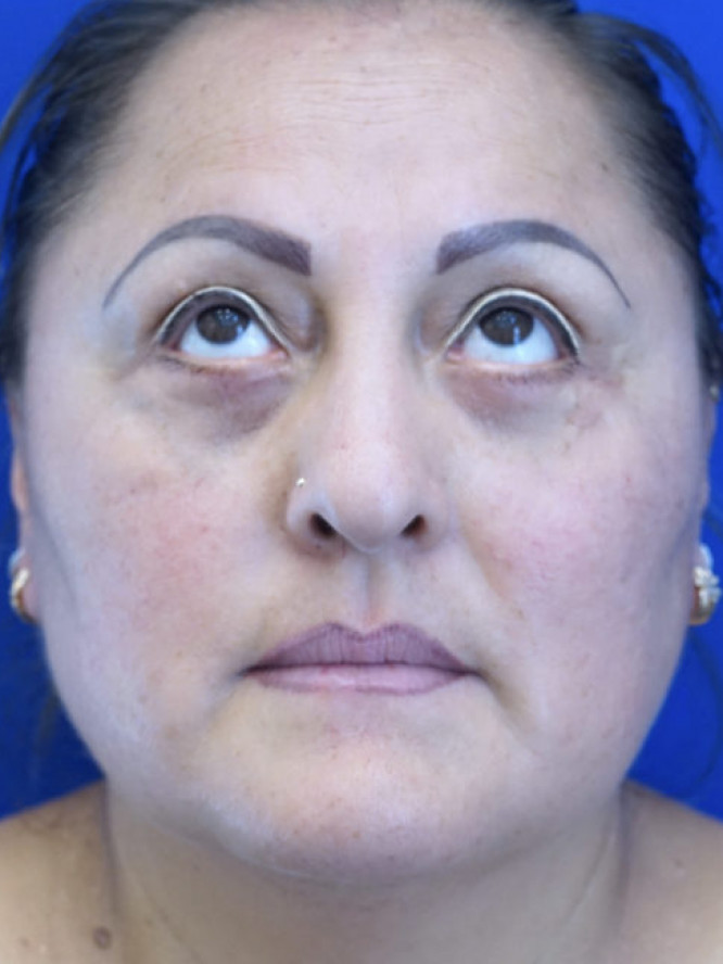 Lower Blepharoplasty Fat Reposition