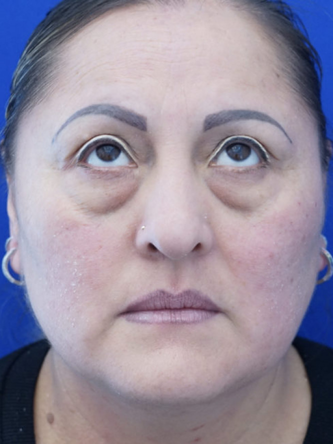 Lower Blepharoplasty Fat Reposition