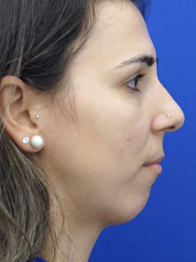 Chin and Nasal Tip Projection