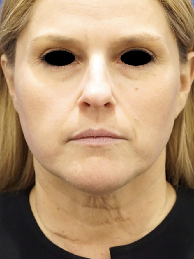 Deep Plane Lower Facelift and Platysmaplasty