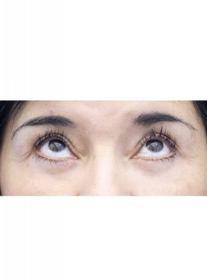 Four Quadrant Blepharoplasty with Fat Reposition