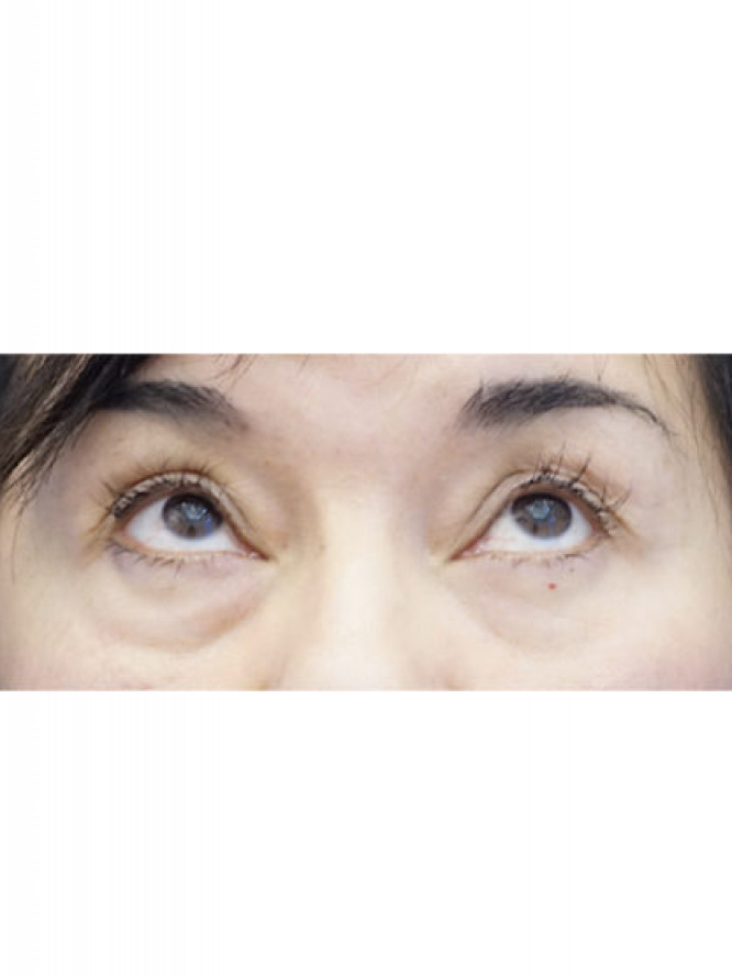 Four Quadrant Blepharoplasty with Fat Reposition