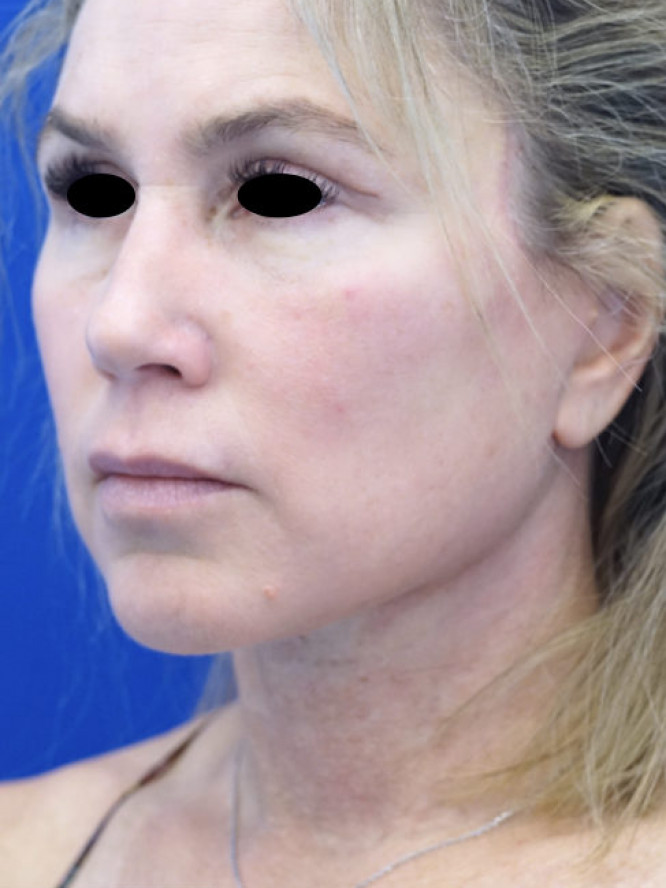 Deep Plane Facelift with Platysmaplasty