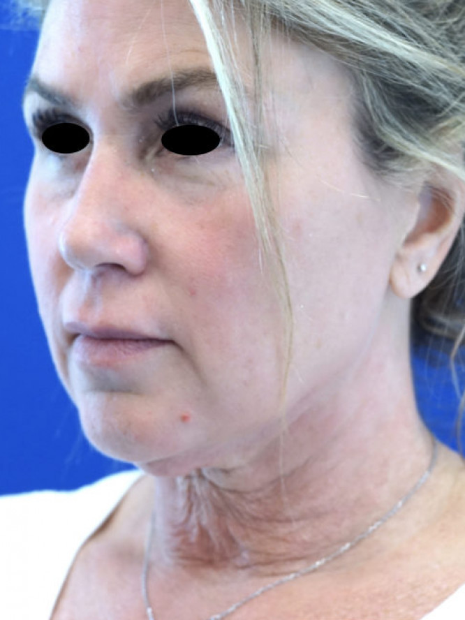 Deep Plane Facelift with Platysmaplasty