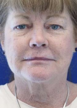 Surgical Neck Lift