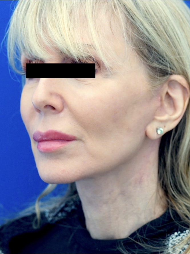 Necklift Lateral Platysma Suspension