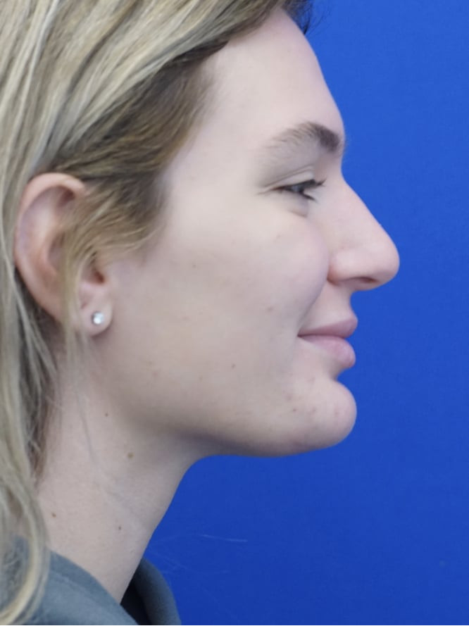 Soft Tissue Chin Reduction