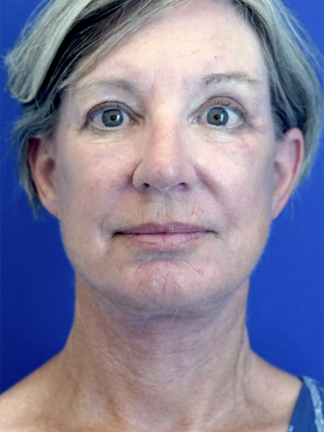 Deep Plane Face and Neck Lift 4565