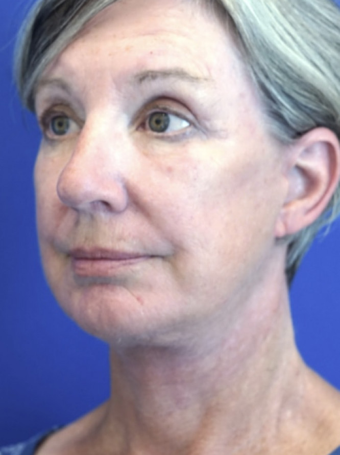 Deep Plane Face and Neck Lift