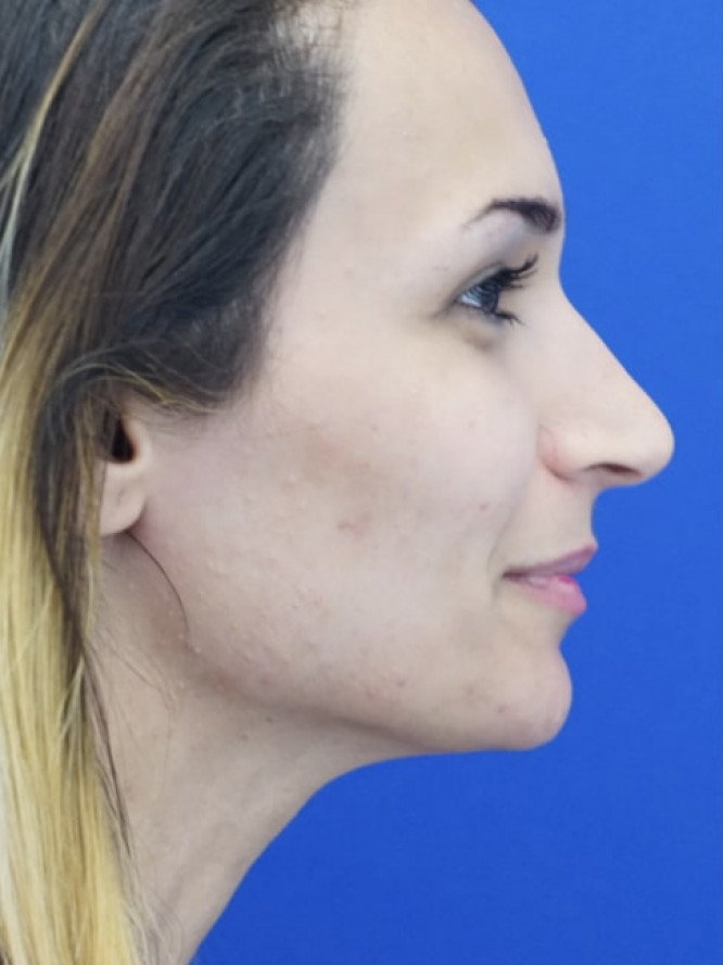 Nasal Deviation and Dainty Tip
