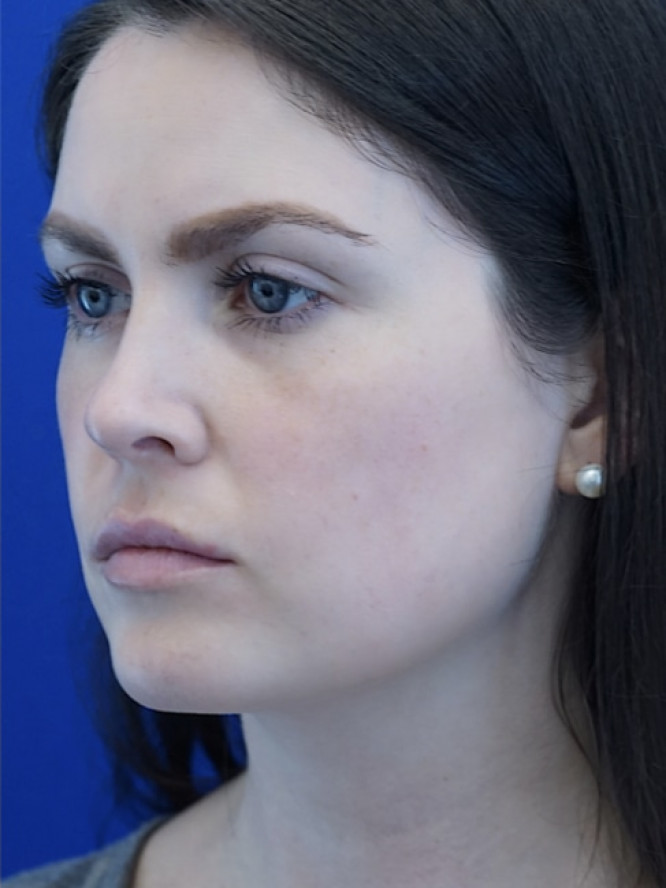 Nasal Tip and Narrow Cheek