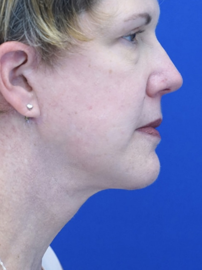 Facelift Platysmaplasty with Subplatysmal Lipectomy