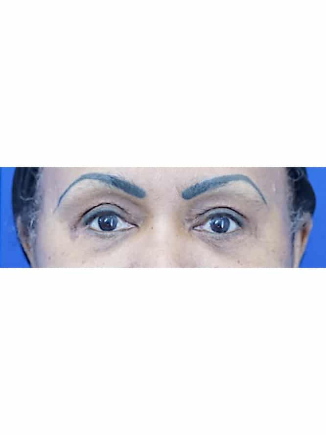 Quad Blepharoplasty Skin Only with Fat Grafting