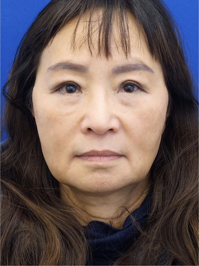 Asian Upper Eyelid Rejuvenation