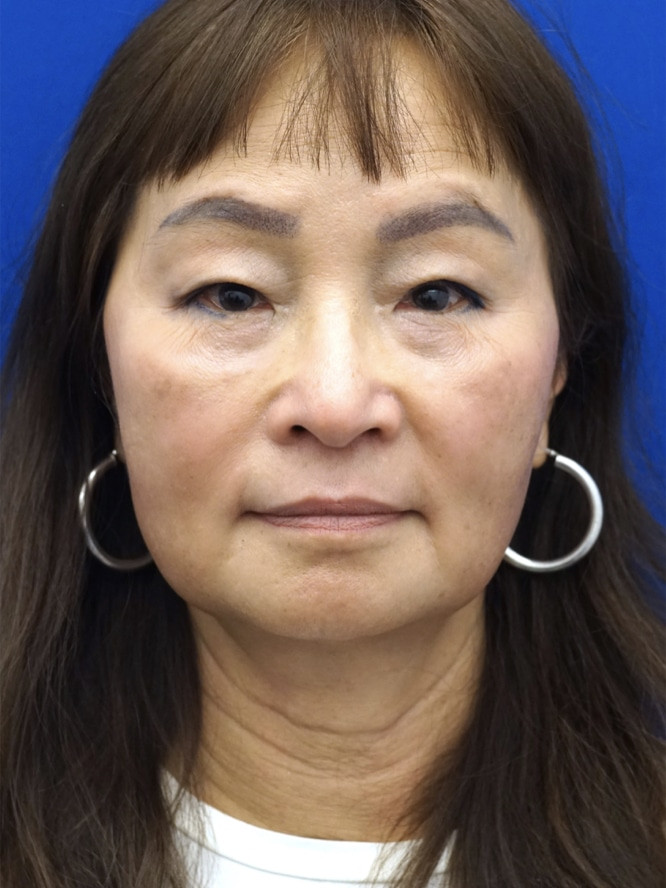 Asian Upper Eyelid Rejuvenation