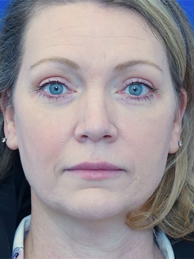 Cosmetic Eyelid Surgery