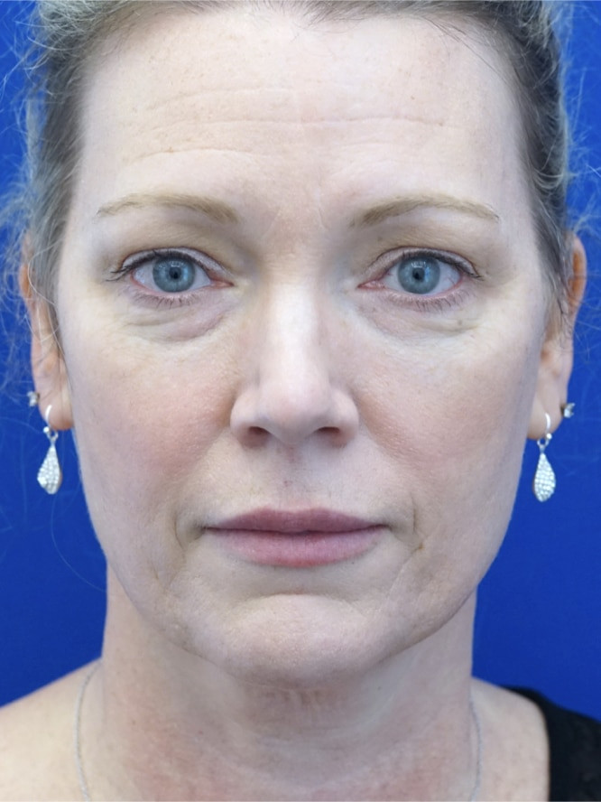 Cosmetic Eyelid Surgery