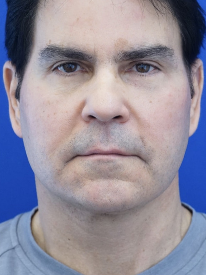 Male Facelift