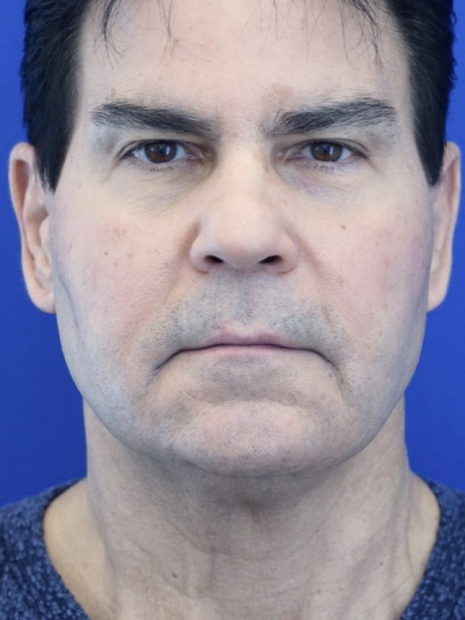 Male Facelift