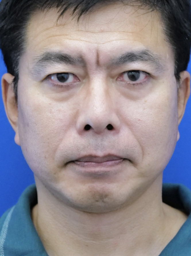 Lower Facial Rejuvenation